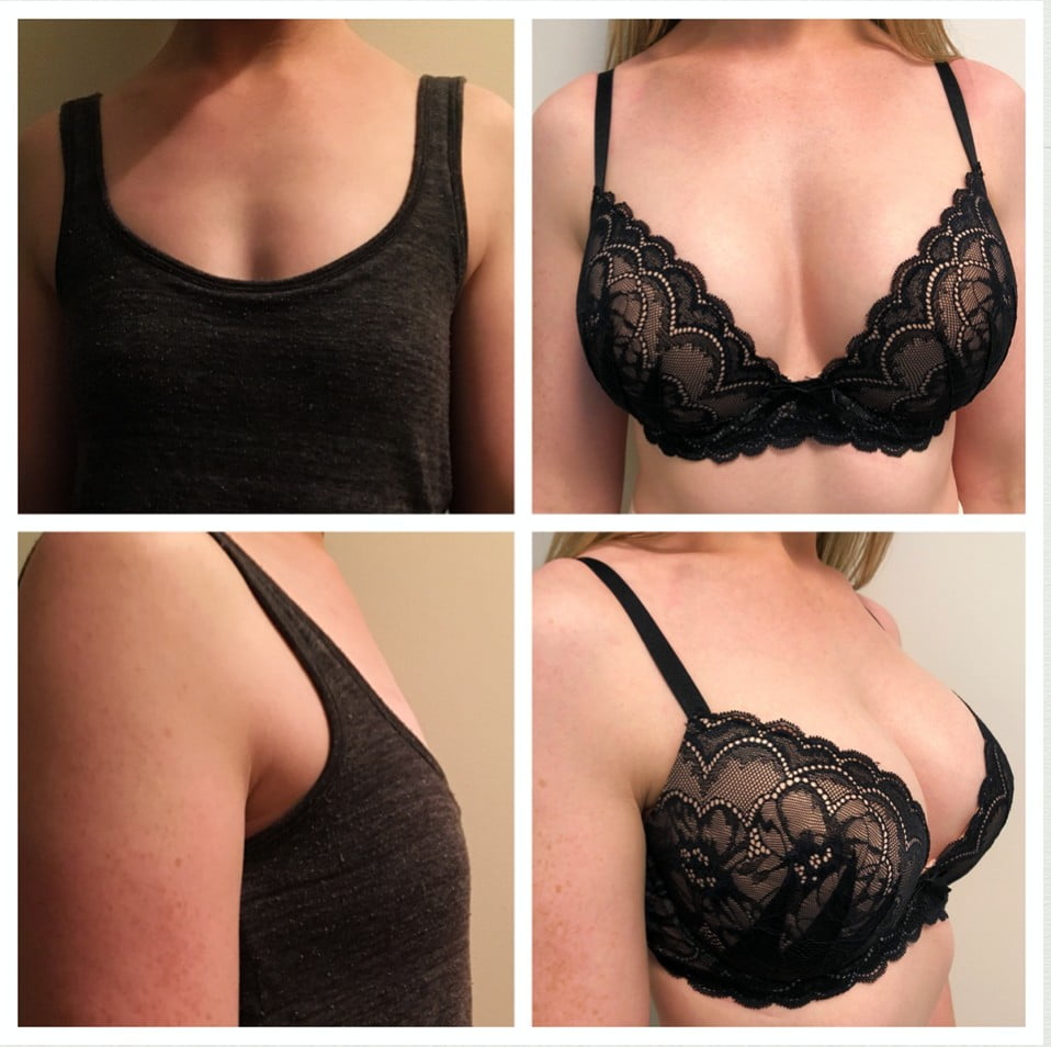 Everything You Need To Know About Breast Augmentation Be Ageless